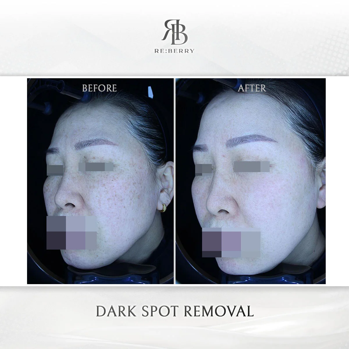 Sun damage pigmentation removal before after result Korea